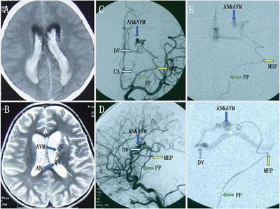 Using a New Landmark of the Most External Point in the Embolization of Distal Anterior Choroidal Aneurysms: A Report of Two Cases